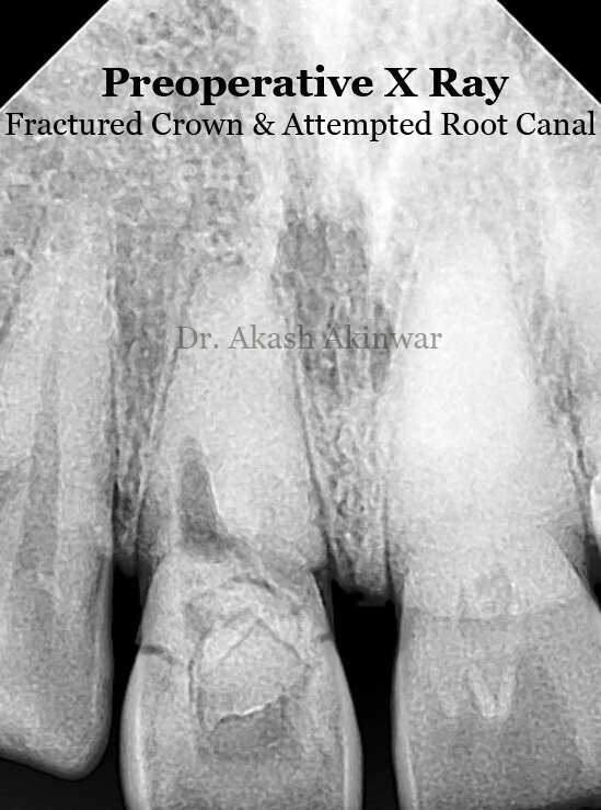 Fig 3: Fractured crown on radiograph