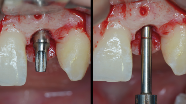 Lateral maxillary incisor implant—Key issues for esthetic success Part II