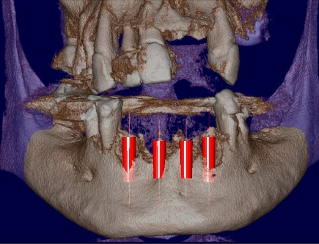 Fig. 4 - Simulazione preimplantare che evidenzia la limitata disponibilità ossea in senso verticale e orizzontale.