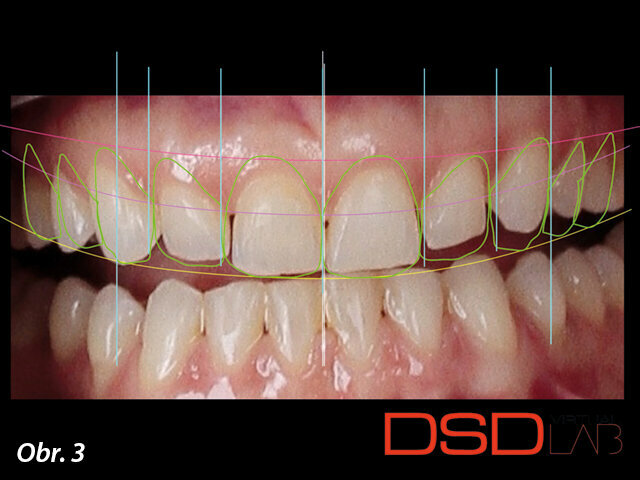 Obr. 3: Digital smile design indikuje prodloužení korunek zubů 13, 12, 11 a 21 a rekonstrukci deseti předních zubů.