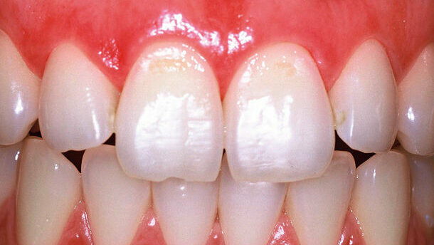 Füllungen im Zahnhalsbereich – mit dem Laser im Vorteil (Teil 1)
