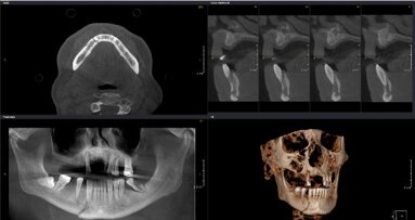 Webinar: Expert gives insights into CBCT-based diagnosis of trauma cases