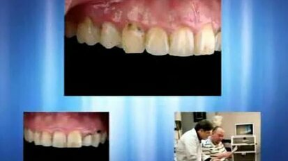 GC presents: EQUIA - Restoring the Posterior Dentition - Case 1