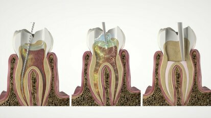 Discover SWEEPS for a more effective endodontic treatment at IDS