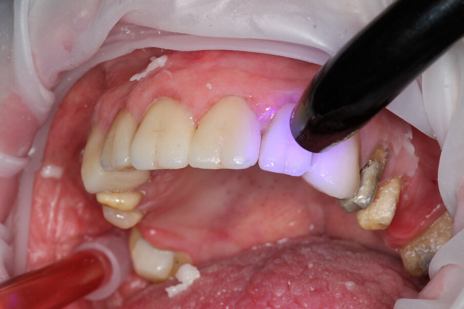 Fig. 26: Light-curing after adhesive bonding of the crowns