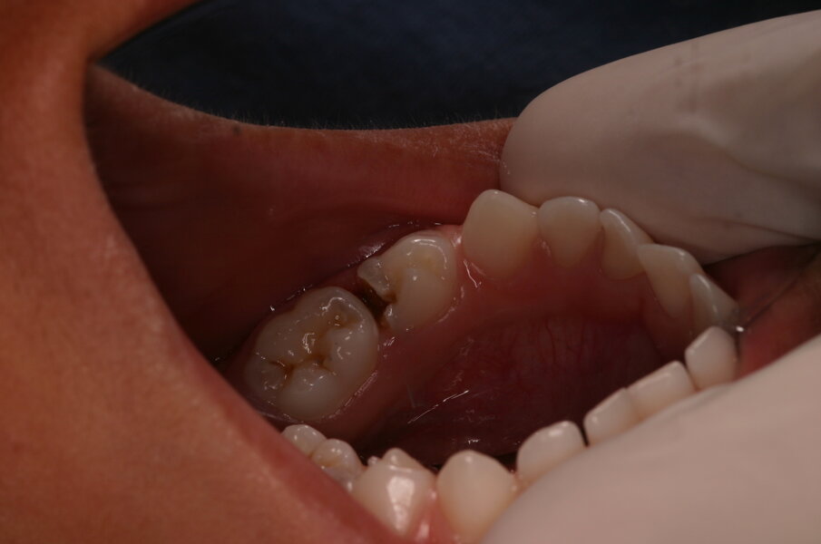Afbeelding 3b. Door geringe druk uit te oefenen fractureert het glazuur en wordt de caviteit groter en toegankelijk voor de tandenborstel.