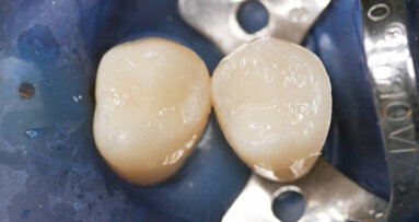 SDR® Plus – The Ideal Bulk-Fill Material in High-C Factor Cavities