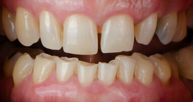 Comprendre la manière dont le bruxisme affecte les restaurations dentaires