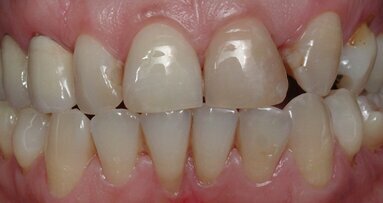 Rehabilitación bucal estética con asistencia de ortodoncia