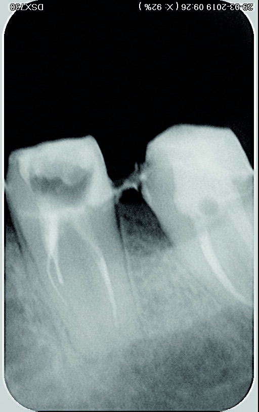 Fig. 1 : Radiographie initiale. 