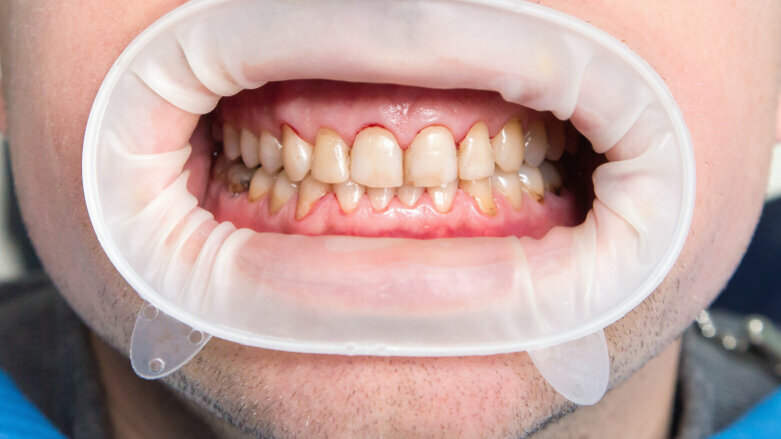 New study offers mechanistic view of dental fluorosis occurrence
