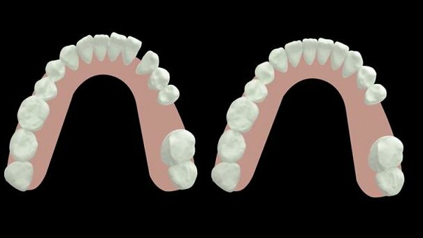 Space management in adults using CAD/CAM aligners―Three case reports