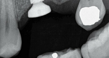 Endodonticko – implantologický algoritmus