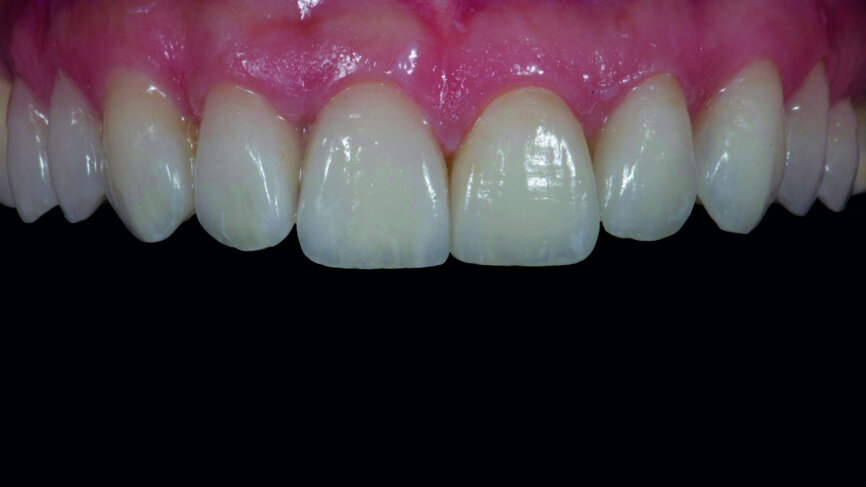 Fig. 15c: First quadrant feldspathic veneers and second quadrant CAD/CAM veneers simultaneously with try-in paste.