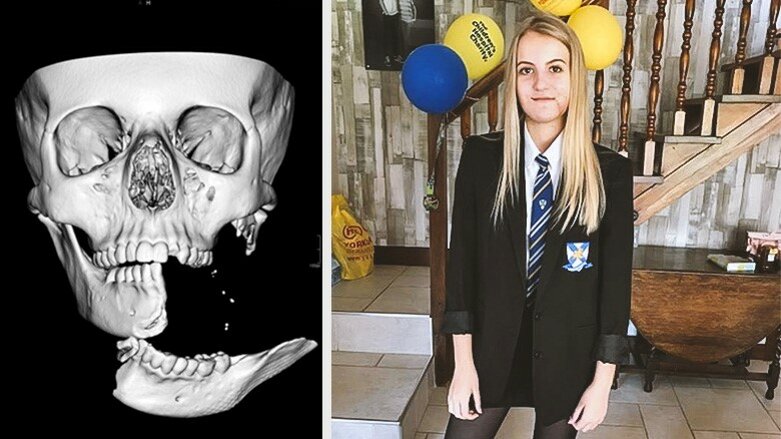 Dreadful horse-riding accident leaves girl with split mandible