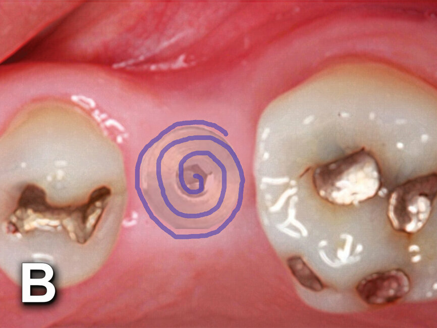 Fig. 4b: Implant to be uncovered (4a) presents with two options depending on width of attached gingiva available. Wide band of attached gingiva will remain after removal of tissue over cover screw, and the diode is utilized in a spiral pattern starting at center until fully exposed (4b). With the narrow band of attached gingiva present, an elliptical cut is made with the diode and tissue is pushed buccally and lingually to preserve the attached gingiva (4c). (Photo provided by Dr. Gregori M. Kurtzman)