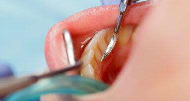 Study offers new insights into dental caries development and prevention