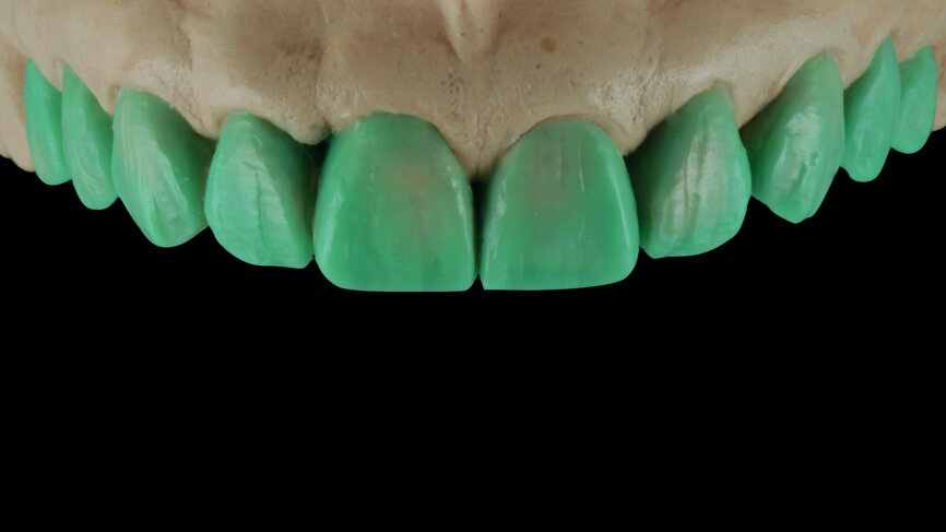 Fig. 4: Wax-up on the stone model concerning the restorative treatment of the ten anterior teeth.