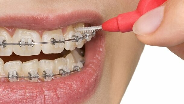 Aparat ortodontyczny i higiena