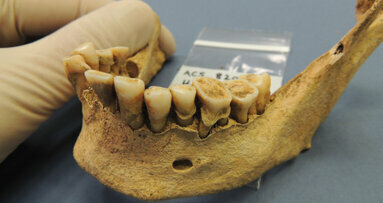 Ancient teeth bacteria track disease evolution