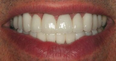Porcelain laminate veneers: an excellent option to correct esthetic and functional problems
