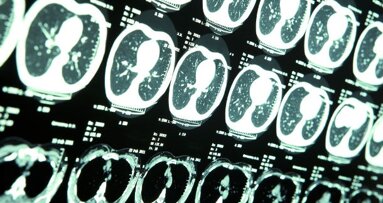 Денталните рентгенови лъчи увеличават риска от доброкачествени, но не и от злокачествени мозъчни тумори