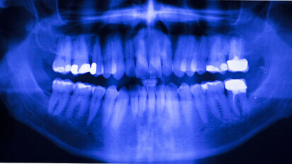 Moving away from amalgam: New online tool helps dentists choose suitable restorative materials