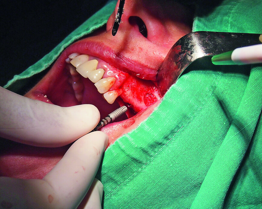 Fig. 7: Placement of a GC Aadva Standard 3.3 x 12.0 mm implant in the premolar region after the sinus graft.