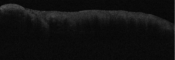 Fig. 3c - Immagine Optical Coherence Tomography (OCT) di Carcinoma orale in paziente donna di 86 anni.