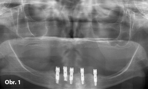 Předoperační snímek pěti stěsnaných implantátů ve frontálním úseku mandibuly
