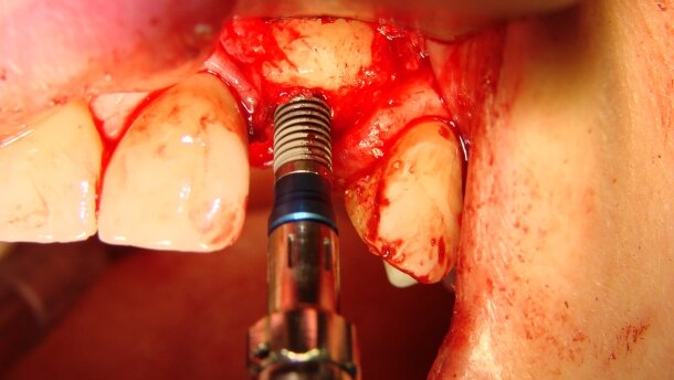 Rekonstrukcja blokiem allogennym wyrostka zębodołowego i wszczepienie implantu