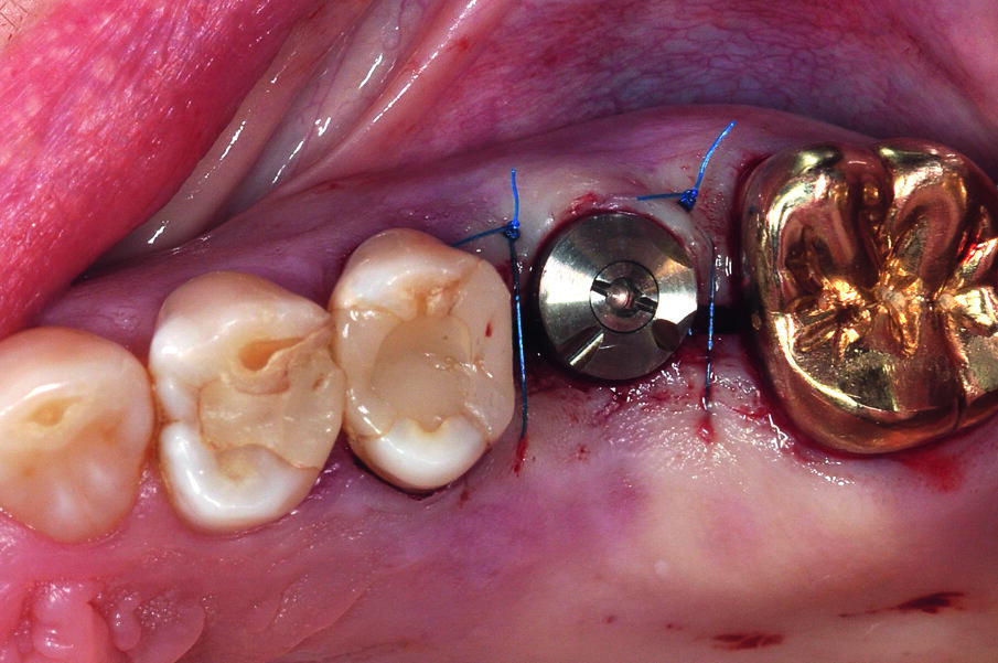 Fig. 5: The gingiva former was screwed on, and the surgical area was microsurgically sutured.