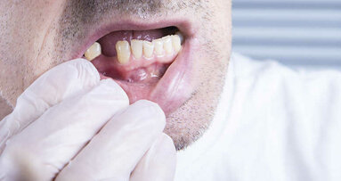 FDI objavila nove smernice za tretman pacijenata sa parcijalnom denticijom