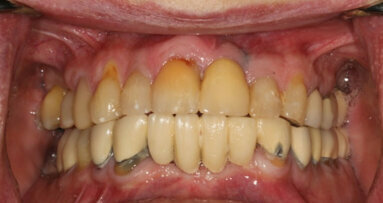 Immediate full-arch zirconia implant therapy utilising the power of robotic assistance and digital scanning