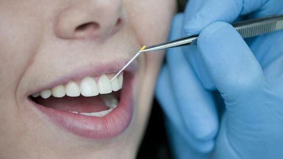 Nový čip urychluje detekci parodontálních bakterií
