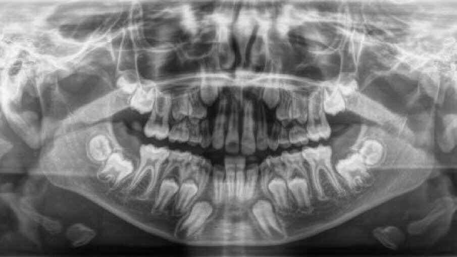 Fig. 3_RX OPT prima del trattamento ortodontico.
