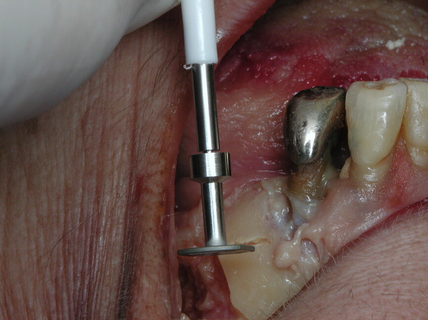 Fig 2a : Implant spécifique : Diskimplant (Photo EPSON)