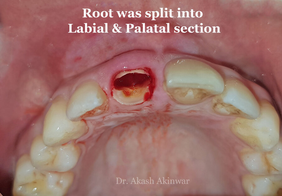 Fig 11: After sectioning of the root
