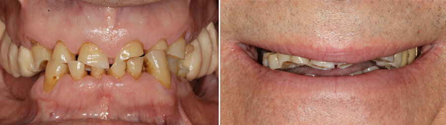 Figs 1A- B: Dentition damaged by bruxism with partially edentulous arches and severe loss of vertical dimension