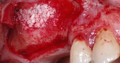 Podstawowe zasady zespalania tkanek miękkich  i wybór materiałów szewnych w chirurgii jamy ustnej