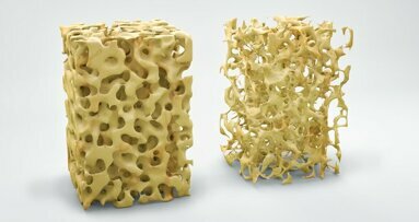 Osteoporose: Implantes de magnésio que dissolvem podem promover a formação óssea