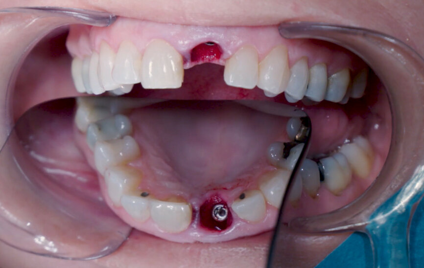 Fig. 11: Final implant position assessment.