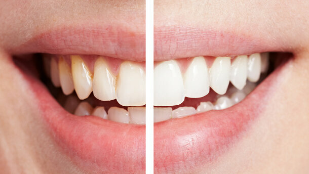 Les bars à sourire ne sont peut être pas le meilleur choix pour un blanchiment dentaire