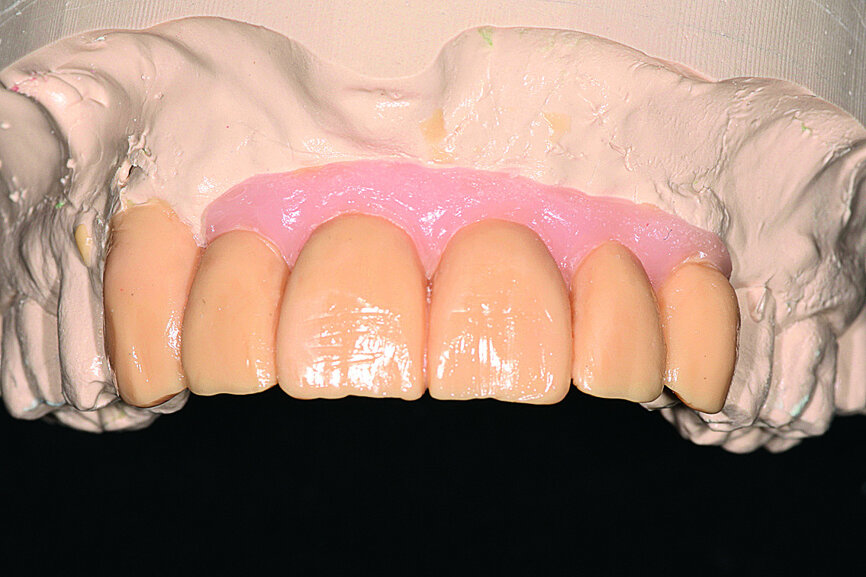 Fig. 11: Increased vestibular bone volume allowed positioning of the teeth at the crestal bone level and reduction of the false gingiva.