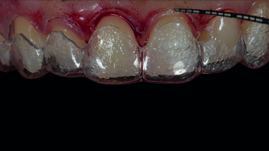 Figs. 6b: Intraoral fi t of the surgical guide for crown lengthening.