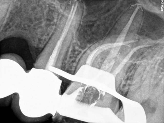 Fig. 3: Post-op radiograph.