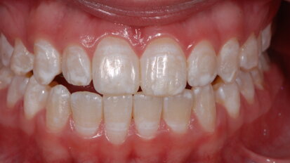 Los efectos adversos del aclaramiento dental