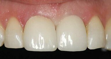Controlling tissue contours with a prosthetically driven approach to implant dentistry