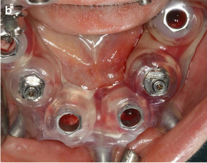 Fig. 8b: Close-up view of the first CAD/CAM guide in situ (tooth- and mucosa-supported) showing the perfect fit on tooth #33 (a). Occlusal view of the second CAD/CAM  guide (implant- and mucosa-supported) after extraction of teeth #42 and 33 and placement of implants in positions #44 and 35 (b). 