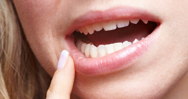Calcium in tooth-whitening gels may reduce sensitivity
